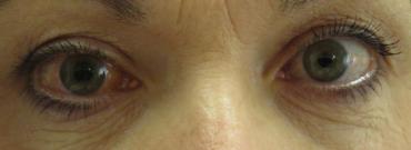 Close up van twee ogen met glaucoom
