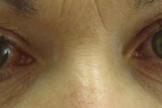 Close up van twee ogen met glaucoom